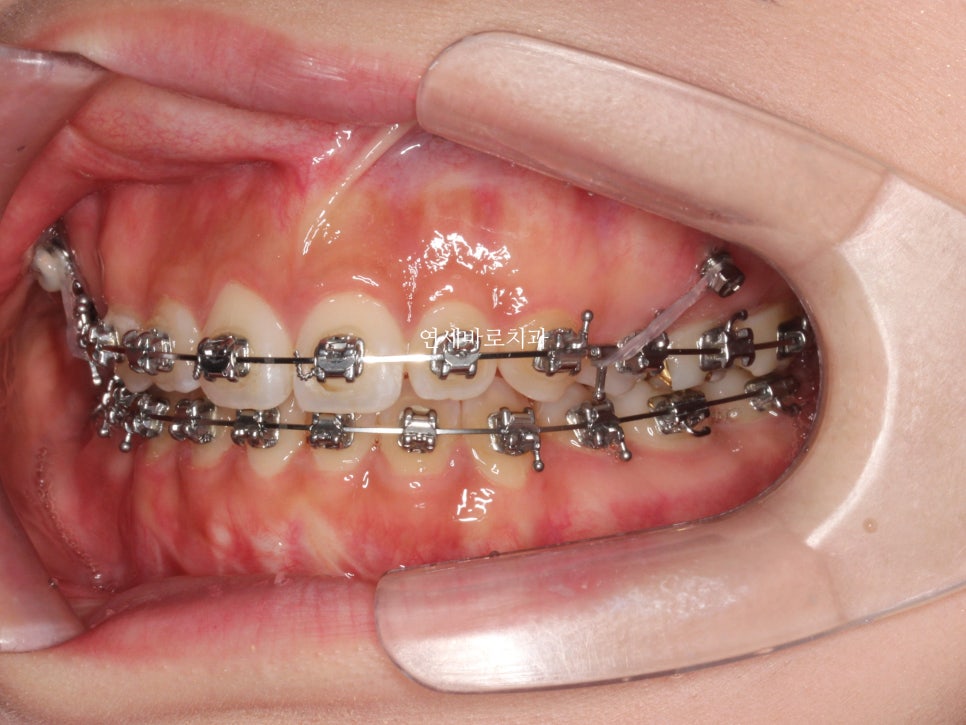 거미스마일 교정치료 전 후 비교