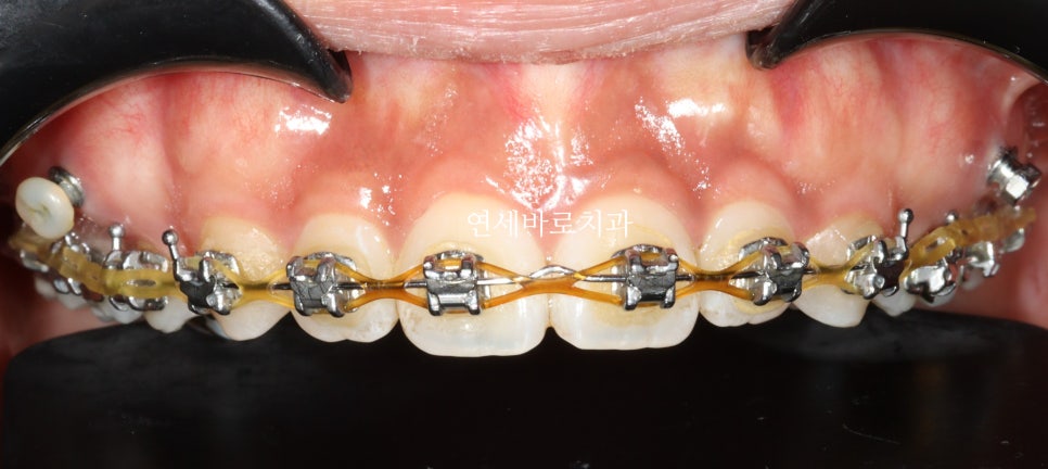 거미스마일 교정치료 전 후 비교