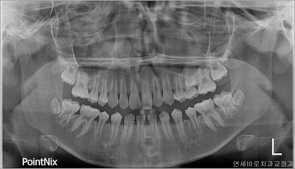 치아 없음 선천적 앞니 결손 _ 임플란트 없이 치료하기
