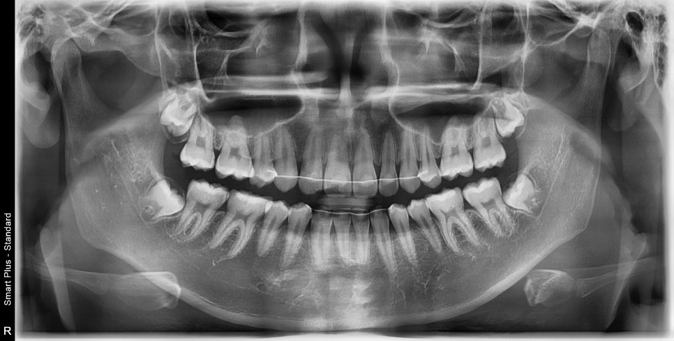 치아 없음 선천적 앞니 결손 _ 임플란트 없이 치료하기