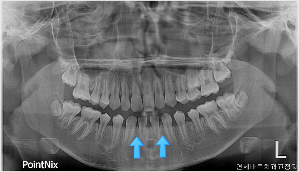 치아 없음 선천적 앞니 결손 _ 임플란트 없이 치료하기