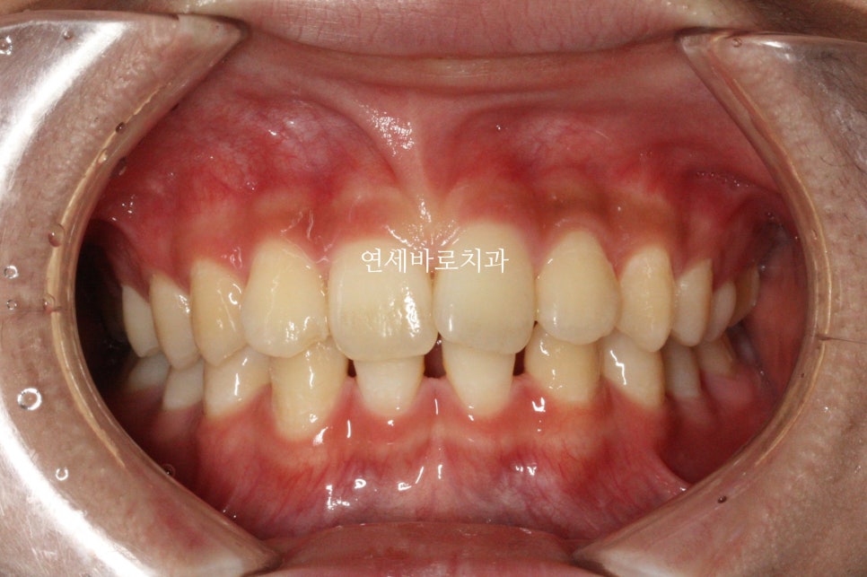 치아 없음 선천적 앞니 결손 _ 임플란트 없이 치료하기