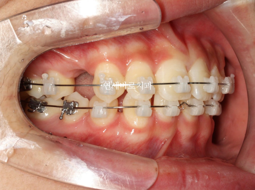 치아 없음 선천적 앞니 결손 _ 임플란트 없이 치료하기