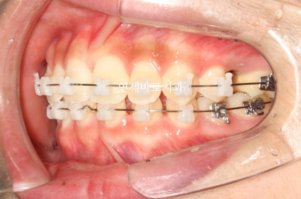 치아 없음 선천적 앞니 결손 _ 임플란트 없이 치료하기