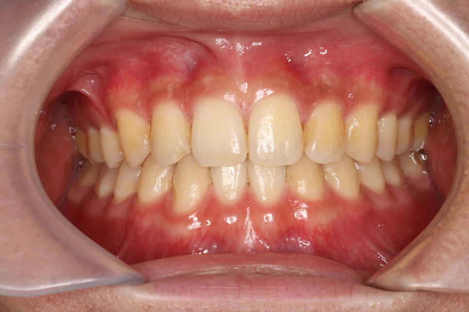 치아 없음 선천적 앞니 결손 _ 임플란트 없이 치료하기
