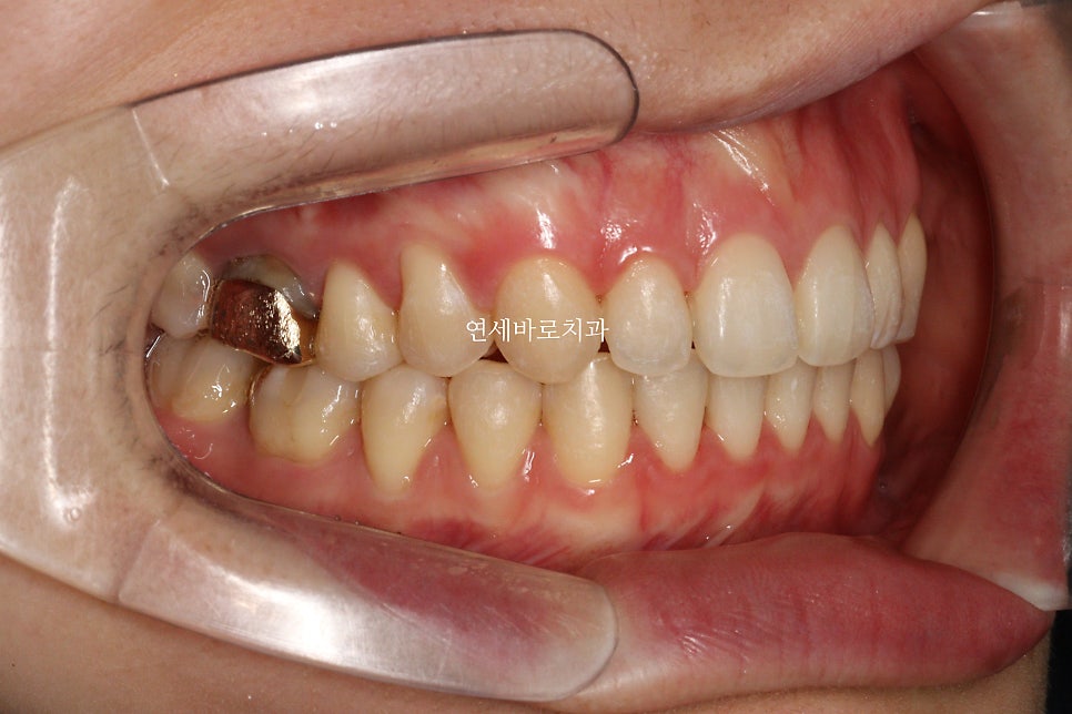 악궁확장을 해야하나요? 왜? 글쎄요