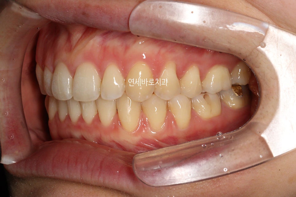 악궁확장을 해야하나요? 왜? 글쎄요