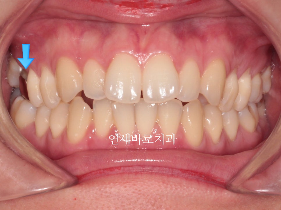 악궁확장을 해야하나요? 왜? 글쎄요