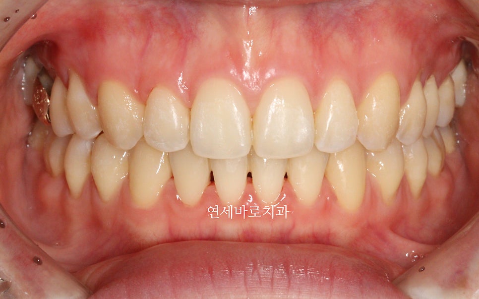 악궁확장을 해야하나요? 왜? 글쎄요