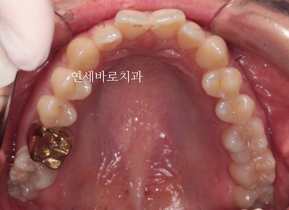 악궁확장을 해야하나요? 왜? 글쎄요