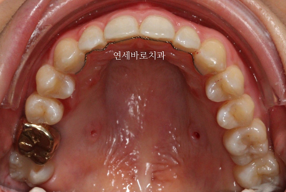 악궁확장을 해야하나요? 왜? 글쎄요