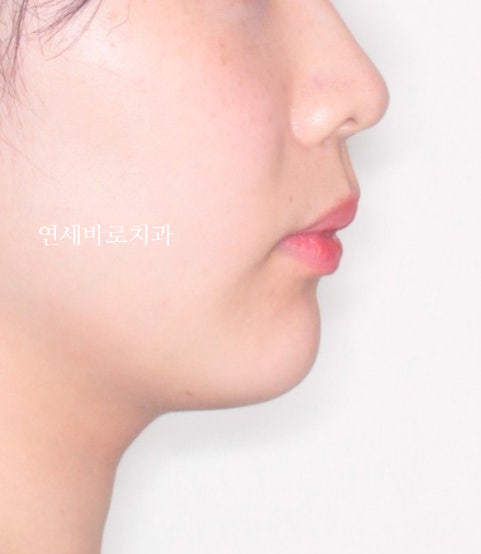 악궁확장을 해야하나요? 왜? 글쎄요