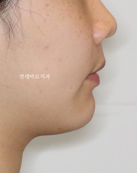 악궁확장을 해야하나요? 왜? 글쎄요