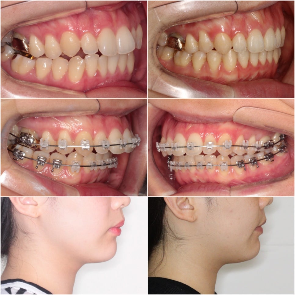 악궁확장을 해야하나요? 왜? 글쎄요