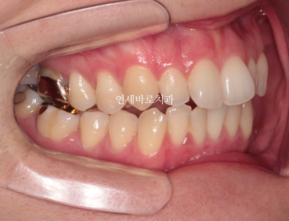 악궁확장을 해야하나요? 왜? 글쎄요