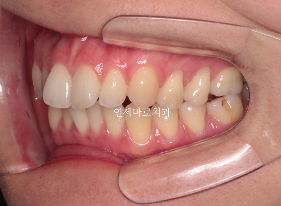 악궁확장을 해야하나요? 왜? 글쎄요