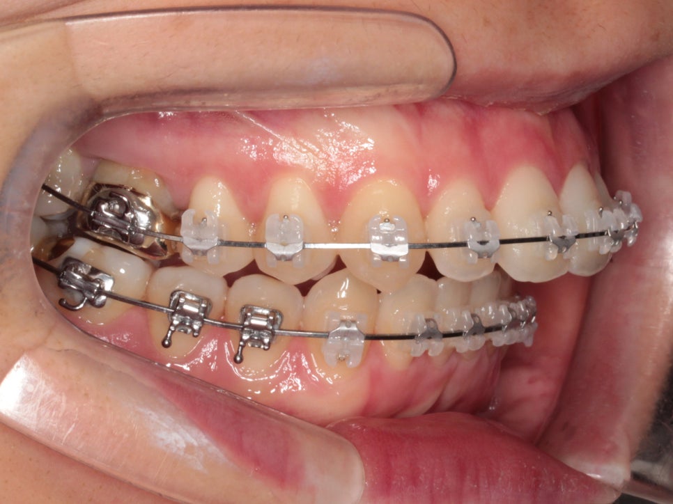 악궁확장을 해야하나요? 왜? 글쎄요