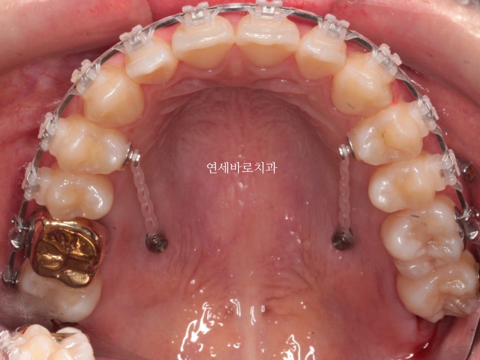 악궁확장을 해야하나요? 왜? 글쎄요