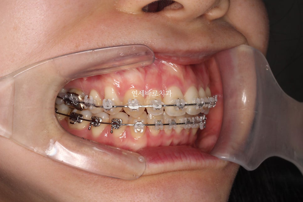 악궁확장을 해야하나요? 왜? 글쎄요