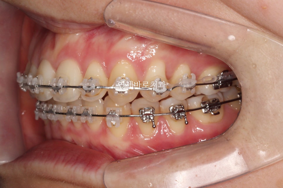 악궁확장을 해야하나요? 왜? 글쎄요