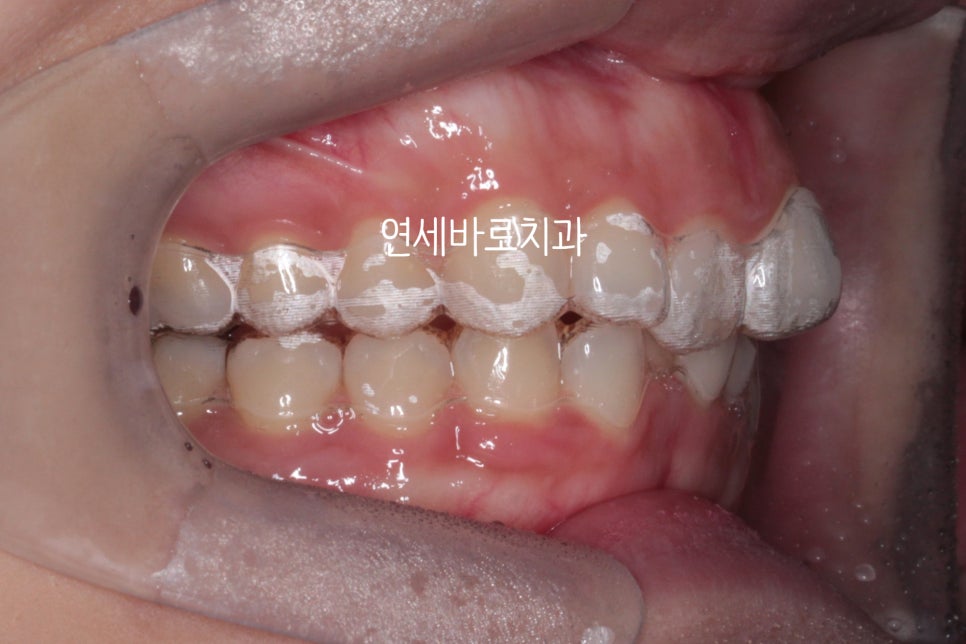 인비절라인 치료 전 후 후기 기록 : : 인천 인비절라인 많이 하는 연세바로치과 "블루다이아몬드" 등급 기념