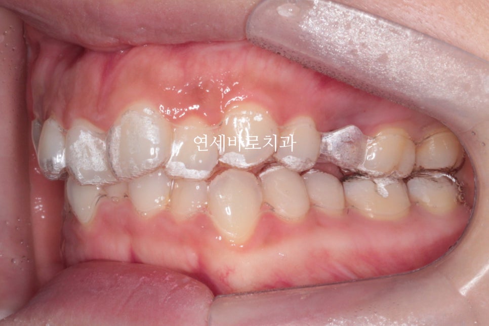 인비절라인 치료 전 후 후기 기록 : : 인천 인비절라인 많이 하는 연세바로치과 "블루다이아몬드" 등급 기념