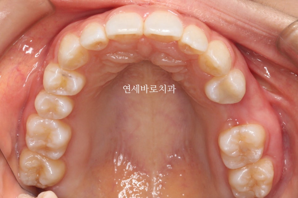 인비절라인 치료 전 후 후기 기록 : : 인천 인비절라인 많이 하는 연세바로치과 "블루다이아몬드" 등급 기념