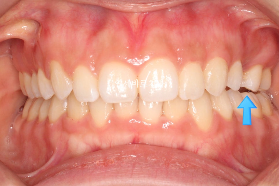 인비절라인 치료 전 후 후기 기록 : : 인천 인비절라인 많이 하는 연세바로치과 "블루다이아몬드" 등급 기념