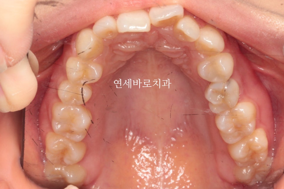 인비절라인 치료 전 후 후기 기록 : : 인천 인비절라인 많이 하는 연세바로치과 "블루다이아몬드" 등급 기념