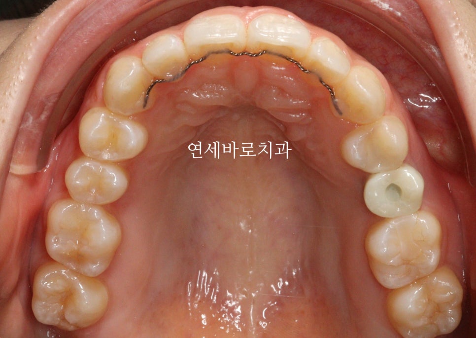 인비절라인 치료 전 후 후기 기록 : : 인천 인비절라인 많이 하는 연세바로치과 "블루다이아몬드" 등급 기념