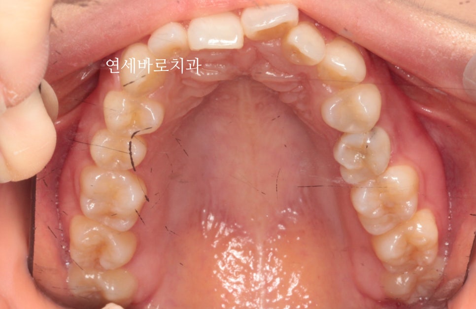 인비절라인 치료 전 후 후기 기록 : : 인천 인비절라인 많이 하는 연세바로치과 "블루다이아몬드" 등급 기념