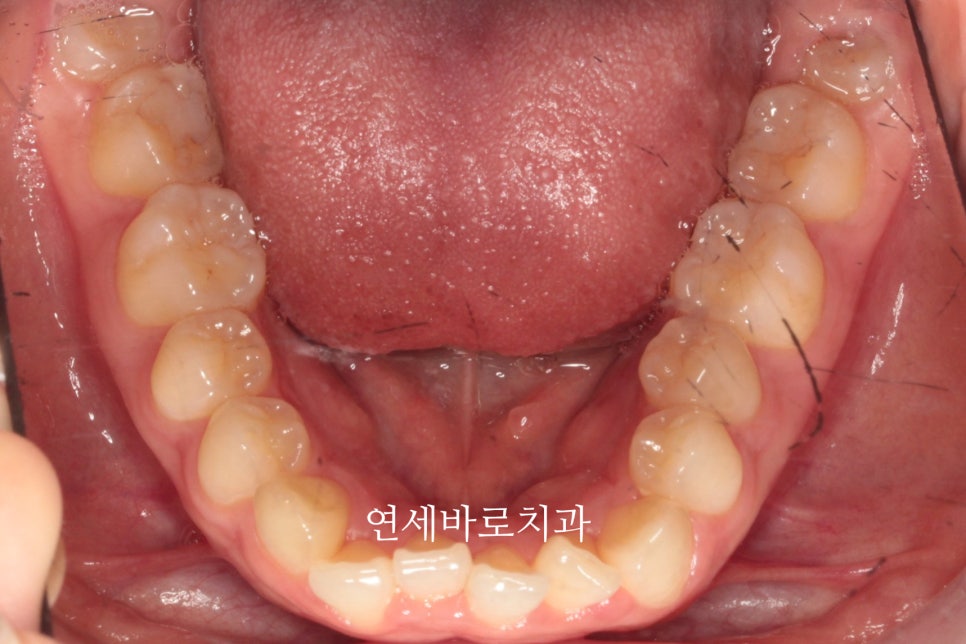 인비절라인 치료 전 후 후기 기록 : : 인천 인비절라인 많이 하는 연세바로치과 "블루다이아몬드" 등급 기념