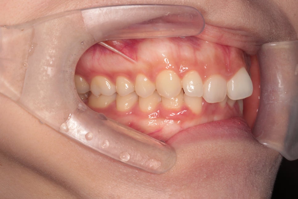 인비절라인 치료 전 후 후기 기록 : : 인천 인비절라인 많이 하는 연세바로치과 "블루다이아몬드" 등급 기념