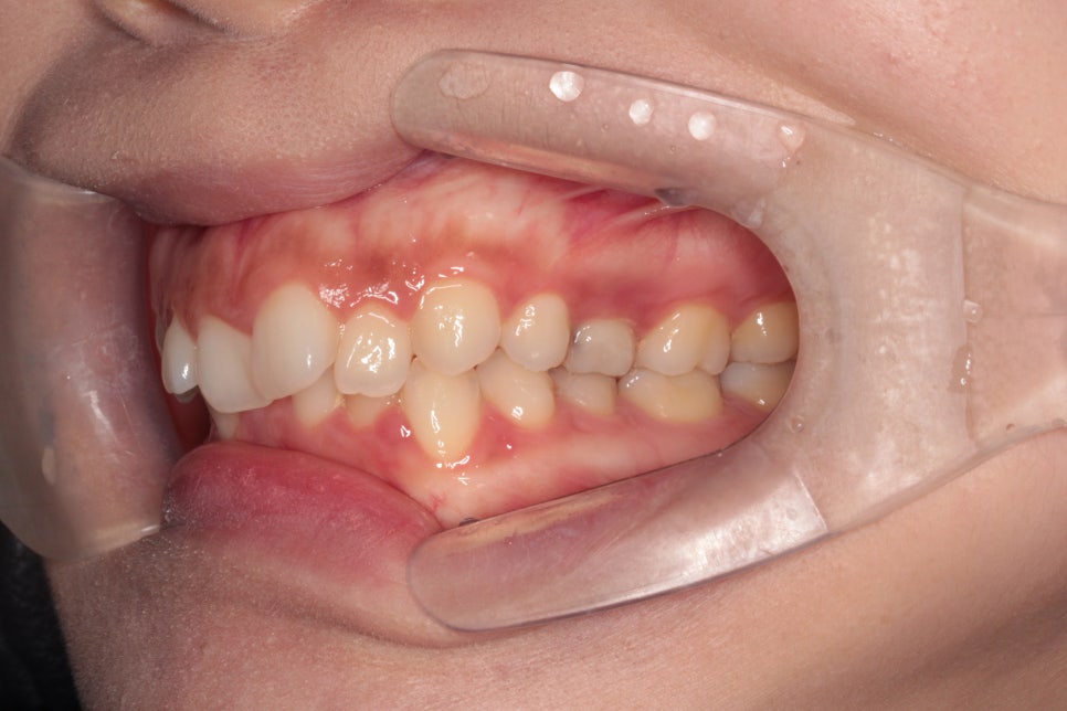 인비절라인 치료 전 후 후기 기록 : : 인천 인비절라인 많이 하는 연세바로치과 "블루다이아몬드" 등급 기념