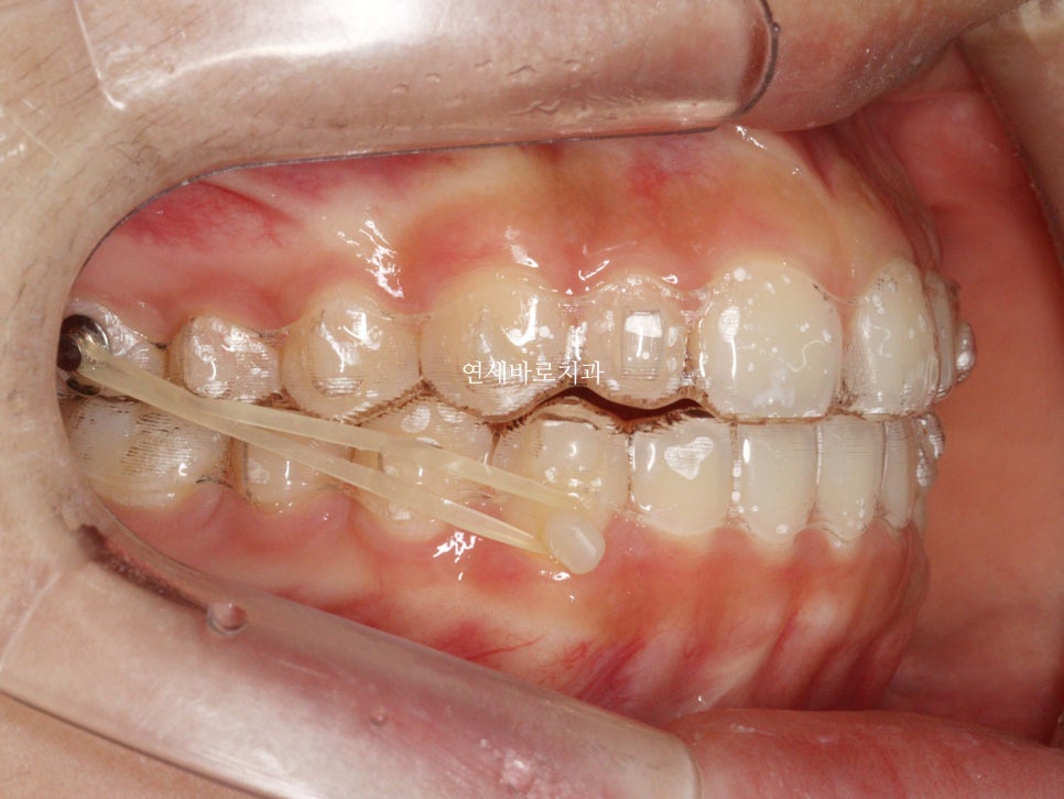 벌어진 앞니 중학생 인비절라인 라이트 와 임시레진 앞니 만들기