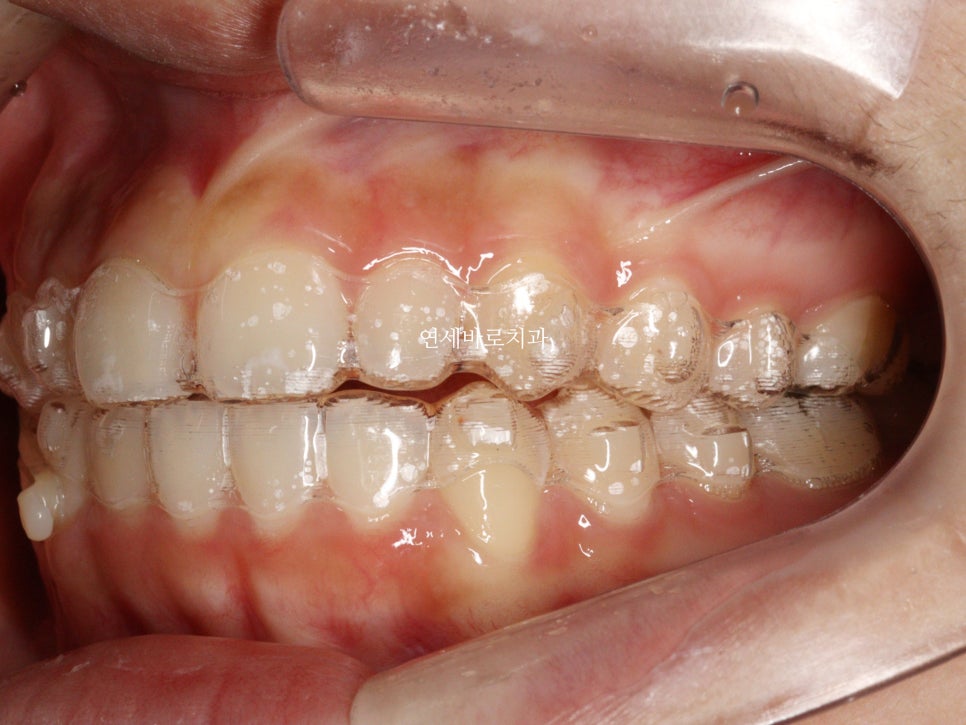 벌어진 앞니 중학생 인비절라인 라이트 와 임시레진 앞니 만들기
