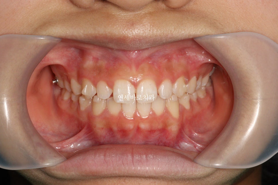 벌어진 앞니 중학생 인비절라인 라이트 와 임시레진 앞니 만들기