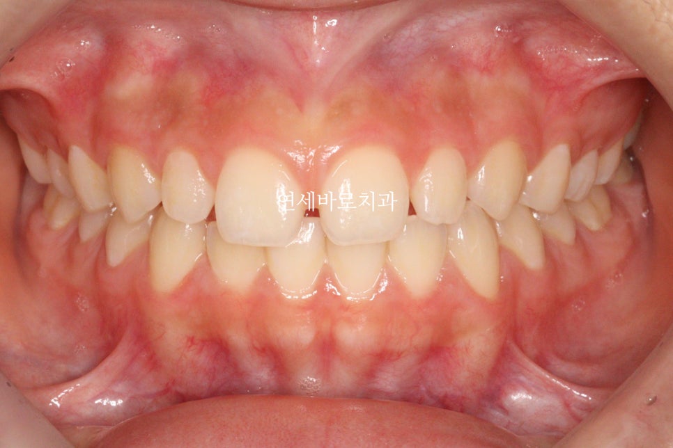벌어진 앞니 중학생 인비절라인 라이트 와 임시레진 앞니 만들기