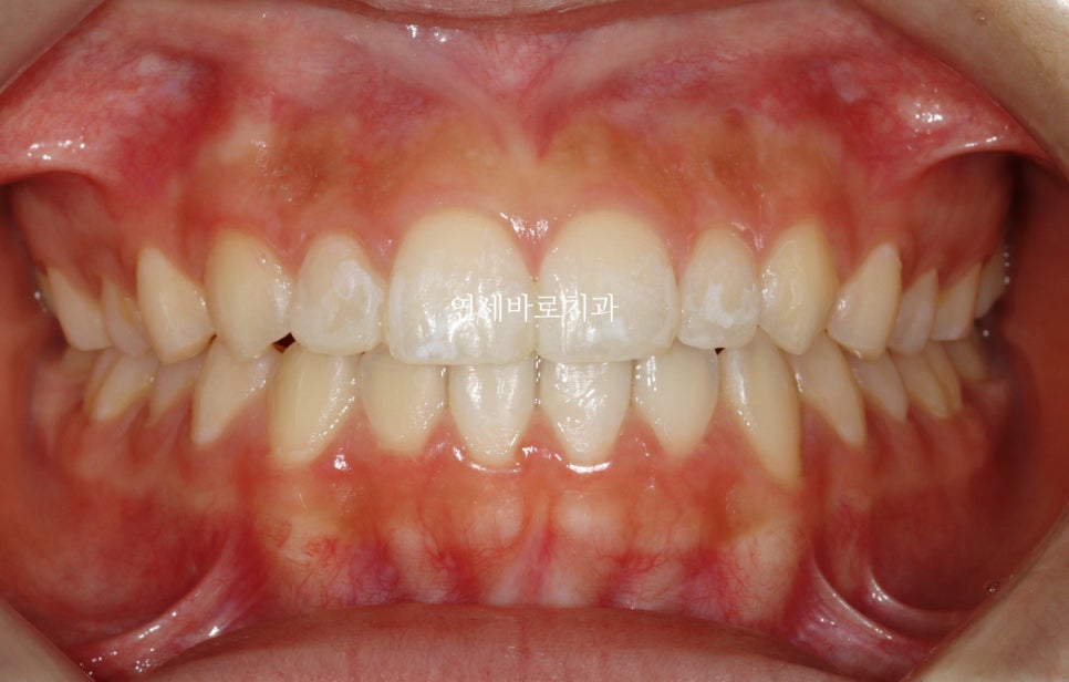 벌어진 앞니 중학생 인비절라인 라이트 와 임시레진 앞니 만들기