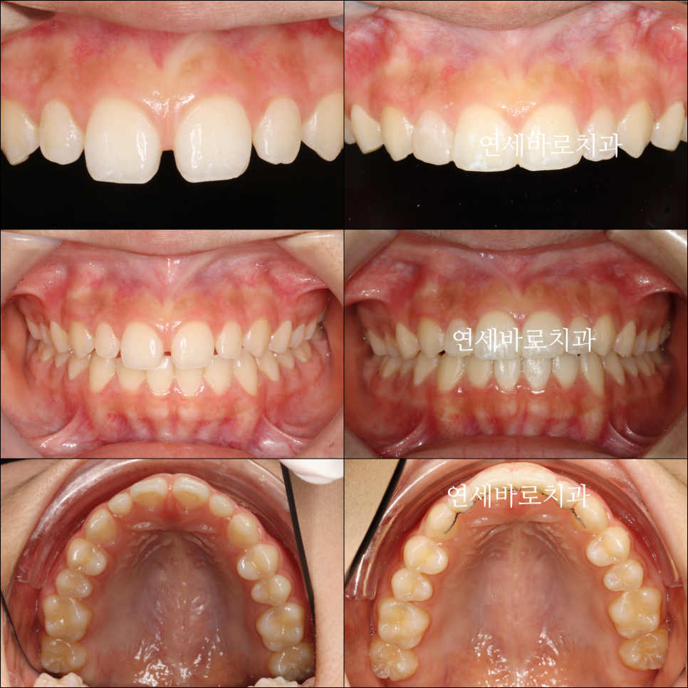 벌어진 앞니 중학생 인비절라인 라이트 와 임시레진 앞니 만들기