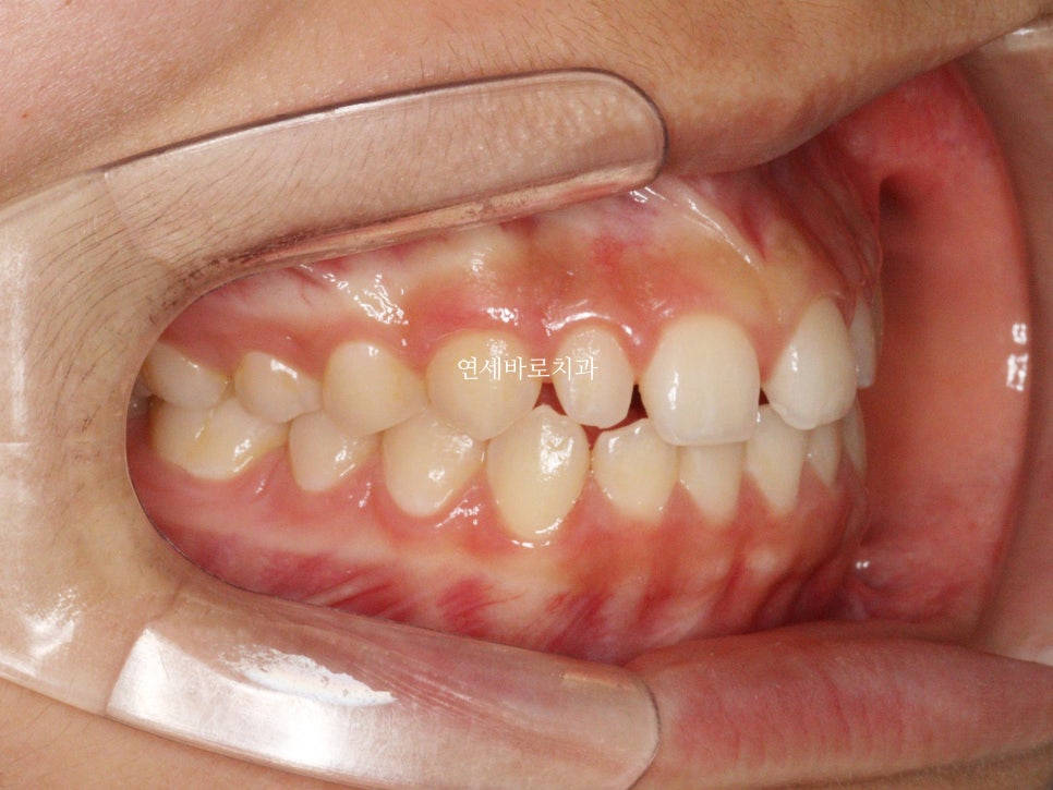 벌어진 앞니 중학생 인비절라인 라이트 와 임시레진 앞니 만들기
