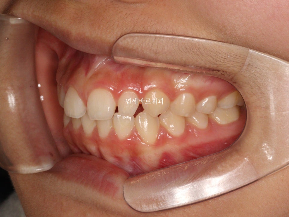 벌어진 앞니 중학생 인비절라인 라이트 와 임시레진 앞니 만들기