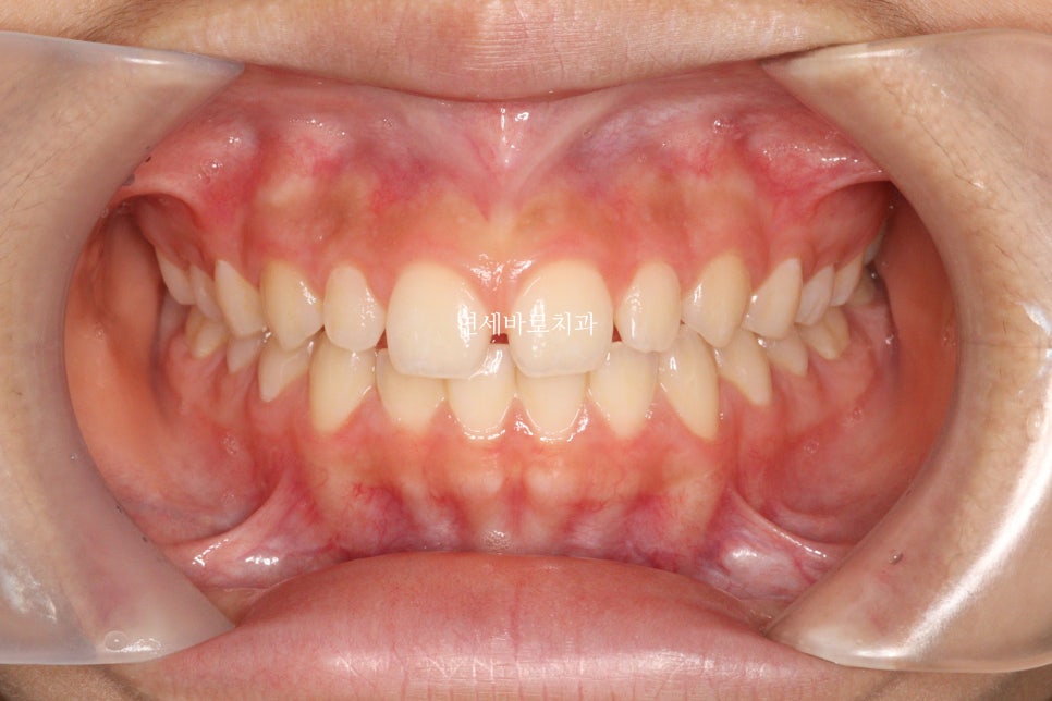 벌어진 앞니 중학생 인비절라인 라이트 와 임시레진 앞니 만들기
