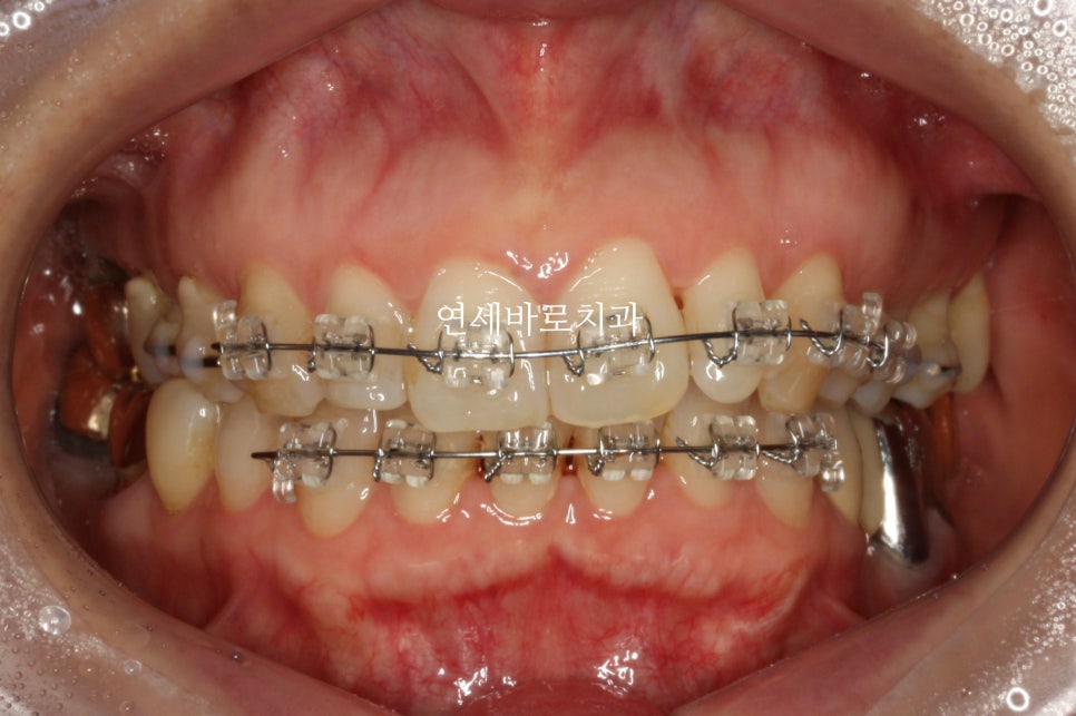 벌어진 앞니 중학생 인비절라인 라이트 와 임시레진 앞니 만들기