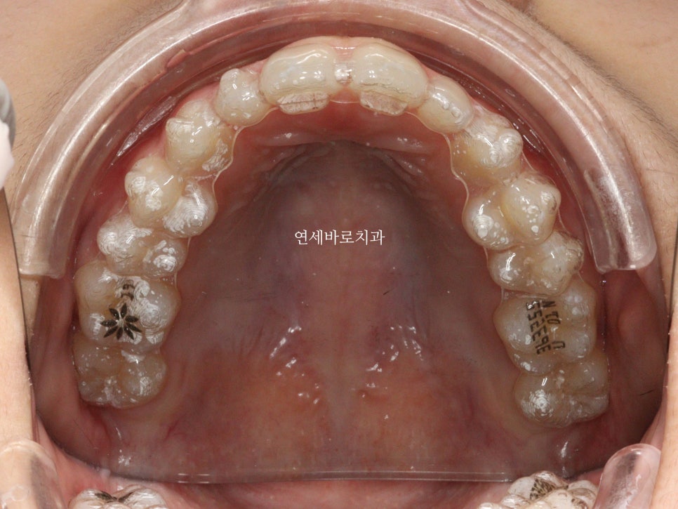 벌어진 앞니 중학생 인비절라인 라이트 와 임시레진 앞니 만들기