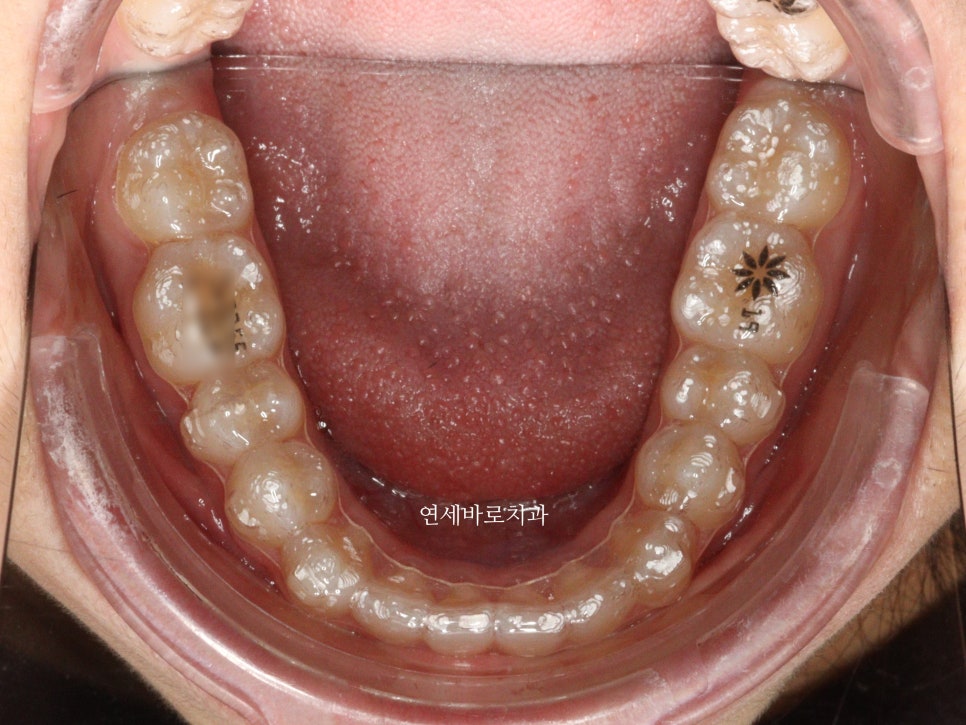 벌어진 앞니 중학생 인비절라인 라이트 와 임시레진 앞니 만들기