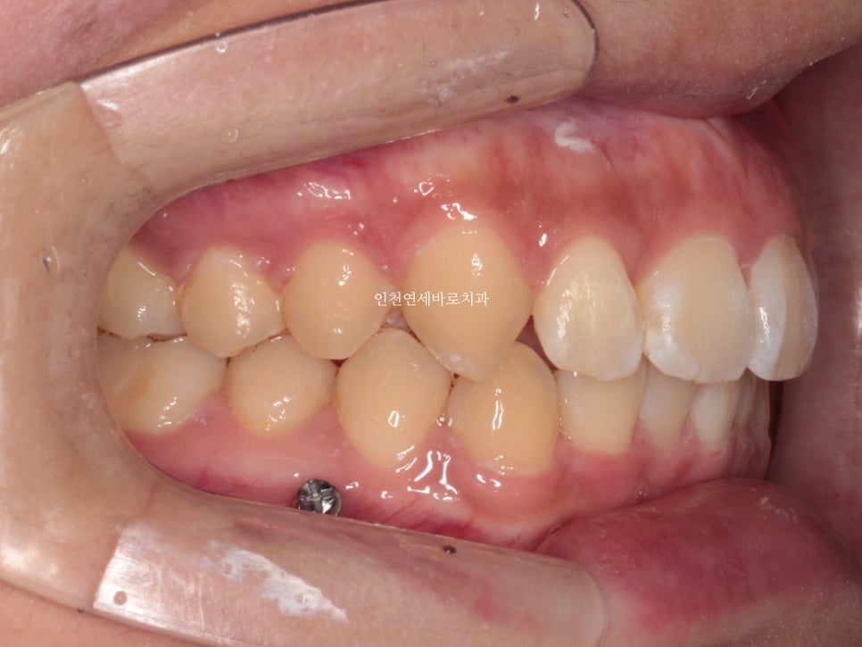 덧니 돌출입 중심선 비발치 교정 치료 후 2년 후 확인