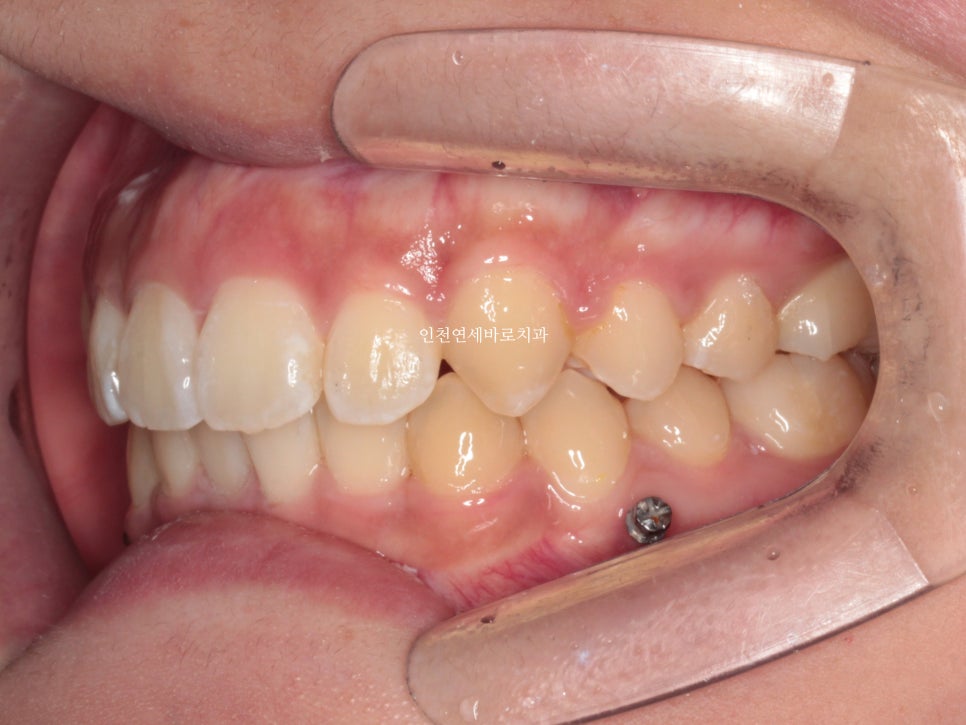 덧니 돌출입 중심선 비발치 교정 치료 후 2년 후 확인