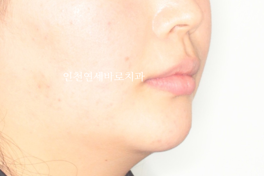 덧니 돌출입 중심선 비발치 교정 치료 후 2년 후 확인