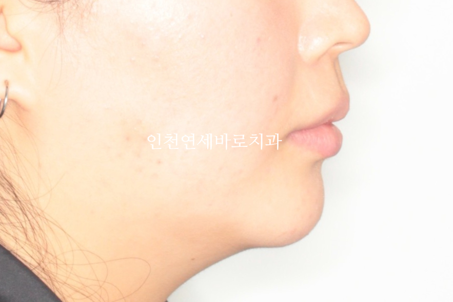 덧니 돌출입 중심선 비발치 교정 치료 후 2년 후 확인